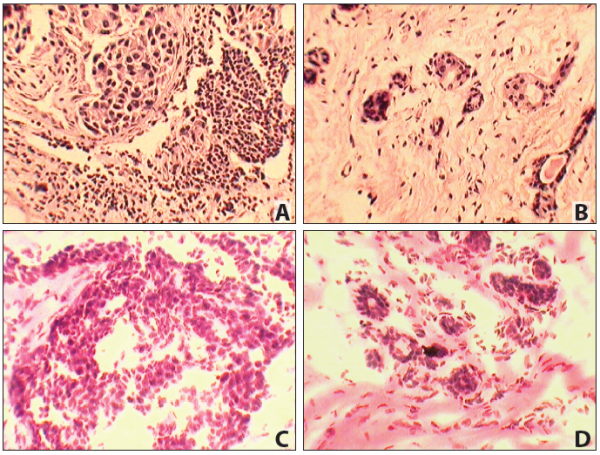 Matched Pair - Frozen Tissue Section - Human Primary Tumor and Normal (PP): Breast