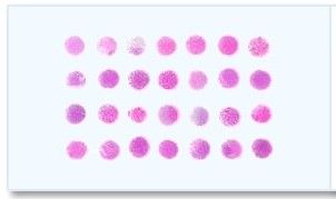 Frozen Tissue Array - 37 Different Ovarian Tumors and 3 Corresponding Normal Controls